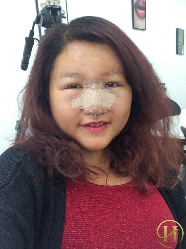 Hình ảnh của Vân sau khi phẫu thuật thẩm mỹ