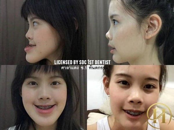 Cô gái có phần xương hàm nhô ra phía trước quá nhiều 