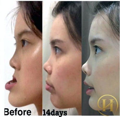 Sự thay đổi bất ngờ sau 14 ngày thực hiện phẫu thuật thẩm mỹ