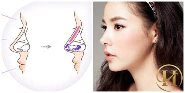 Nâng mũi bọc sụn Hàn Quốc có thể duy trì hiệu quả vĩnh viễn