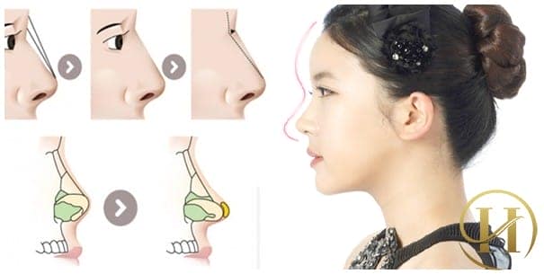 Hình ảnh mô tả tác động của chất làm đầy filler dùng để nâng mũi