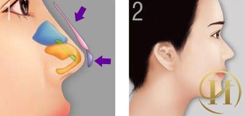 Phẫu thuật nâng mũi mang lại hiệu quả vĩnh viễn cho bạn