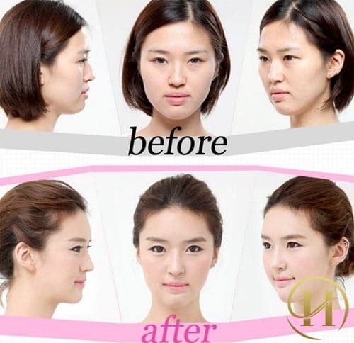 Sự khác biệt sua khi "dao kéo"