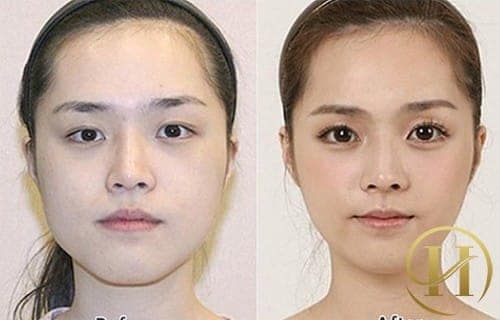 Rất nhiều cô gái đã tìm đến phương pháp nâng mũi để giúp gương mặt thanh tú hơn