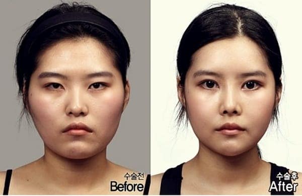 Cô gái nam tính 'lột xác" nhờ phép màu của phẫu thuật thẩm mỹ