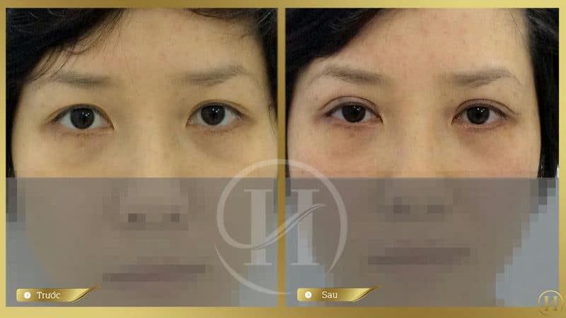 Kết quả trước và sau khi nhấn mí Hàn Quốc tại Dr.Hải Lê