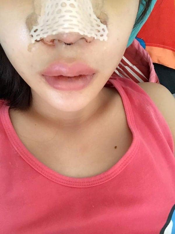 Kim quyết định nâng mũi S-line