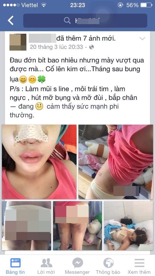 Cô gái trẻ quyết định phẫu thuật thẩm mỹ toàn thân