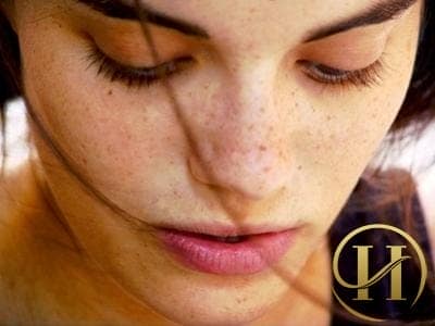 Nám da là nỗi ám ảnh của hầu hết phái đẹp