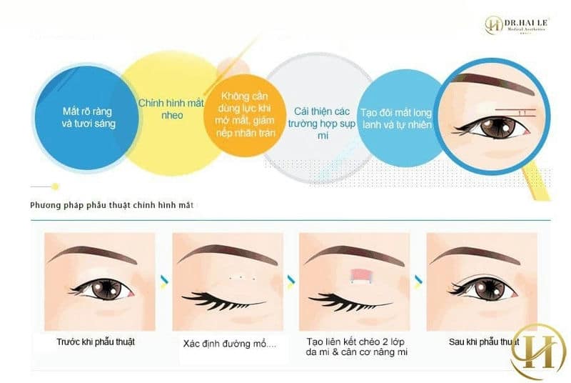 Cắt mí đẹp hải lê