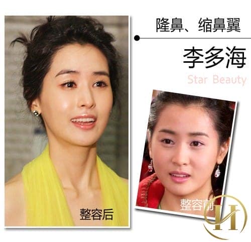Mỹ nhân Lee Dae Hee cũng phải nhờ đến dao kéo