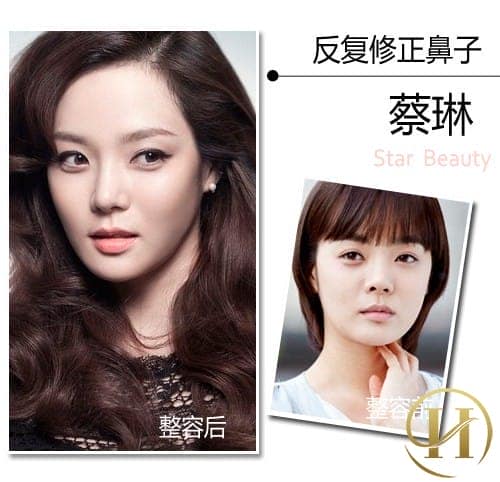 Chae Rim đẹp hơn nhờ nâng mũi.
