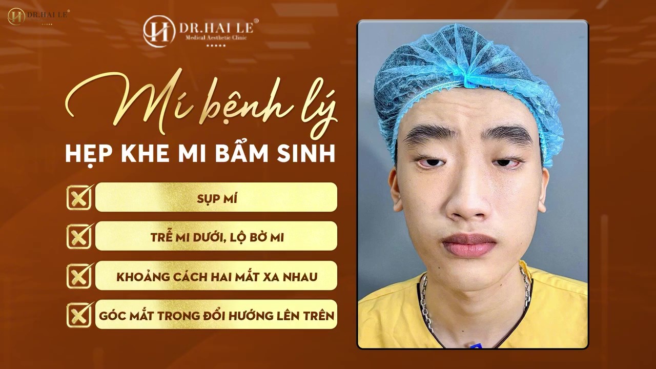 Hành Trình Thức Tỉnh Đôi Mắt “Ngủ Gật” Sau 18 Năm Lờ Đờ Hành Trình Thức Tỉnh Đôi Mắt “Ngủ Gật” Sau 18 Năm Lờ Đờ