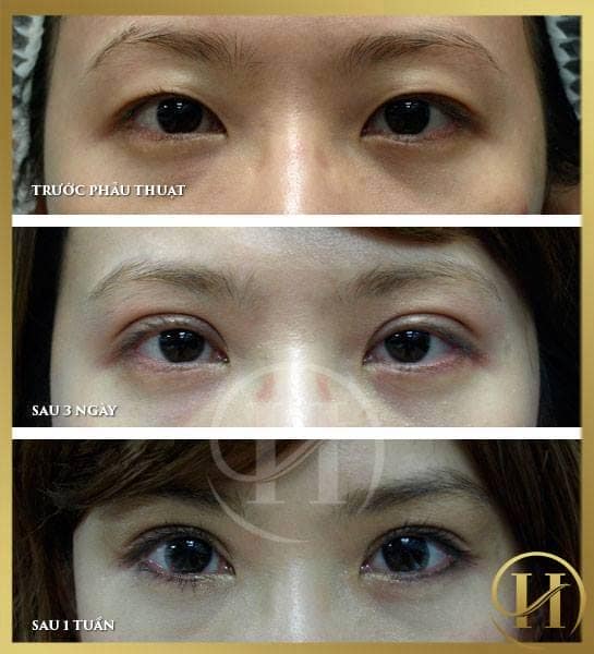 Nhấn mí Thái Lan Deep Eyes có điểm gì khác với nhấn mí Hàn Quốc