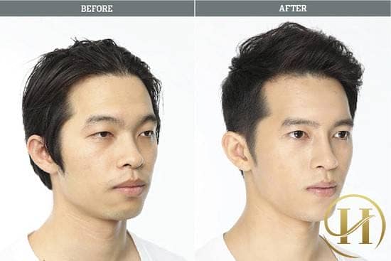 Kết quả trước sau khi độn cằm v-line cho nam