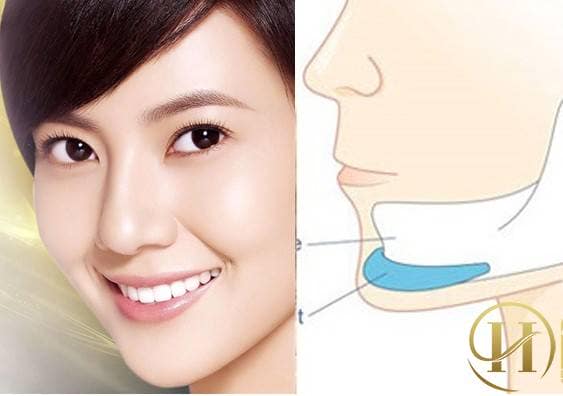 Quy trình độn cằm V-line 
