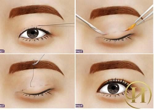 Nhấn mí Thái Lan Deep Eyes có đẹp không?