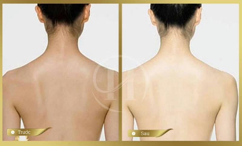 Quy trình làm trắng da bằng Nano Perla White?