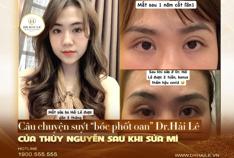 Câu chuyện suýt “bóc phốt” oan Dr.Hải Lê của Thúy Nguyễn sau khi cắt mí