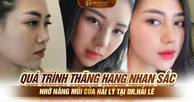 Quá trình thăng hạng nhan sắc nhờ nâng mũi của Hải Lý tại Dr.Hải Lê