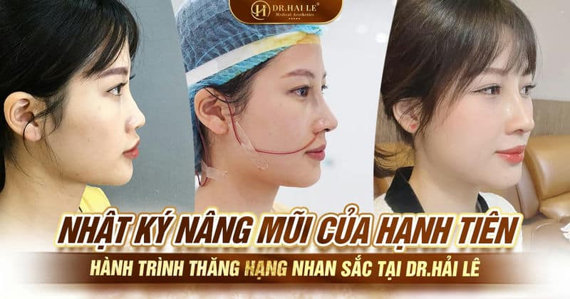 Nhật ký nâng mũi của Hạnh Tiên - Hành trình thăng hạng nhan sắc tại Dr.Hải Lê Nhật ký nâng mũi của Hạnh Tiên - Hành trình thăng hạng nhan sắc tại Dr.Hải Lê