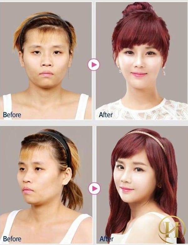Bất ngờ nhận được 5 lời tỏ tình sau khi "dao kéo"