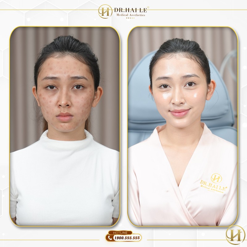 Phương pháp cấy meso trước (ảnh trái) và sau sử dụng (ảnh phải)