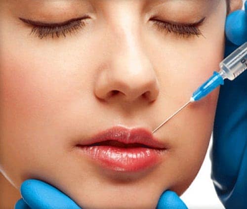  Tiến hành tạo hình môi trái tim với Filler - RF Innofil theo vị trí đã được xác định trước 