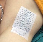  Vẽ sơ đồ tuyến mồ hôi vùng nách 