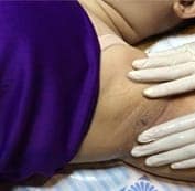  Bôi tê vùng da cần điều trị 