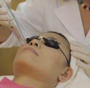  Tiến hành điều trị xóa sẹo lồi 