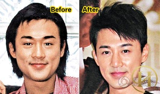 Lâm Phong bị nghi ngờ sửa mũi, gọt mặt Lâm Phong bị nghi ngờ sửa mũi, gọt mặt - sao nam Hoa ngữ phẫu thuật thẩm mỹ