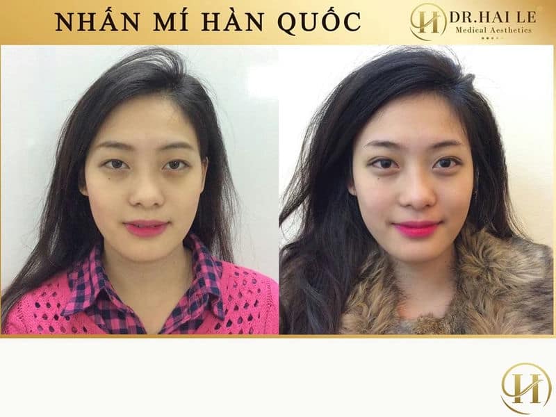 Nhấn mí mắt hàn quốc ở đâu đẹp tại hà nội