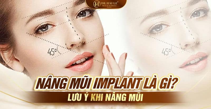 Nâng mũi implant bằng phương pháp gì?