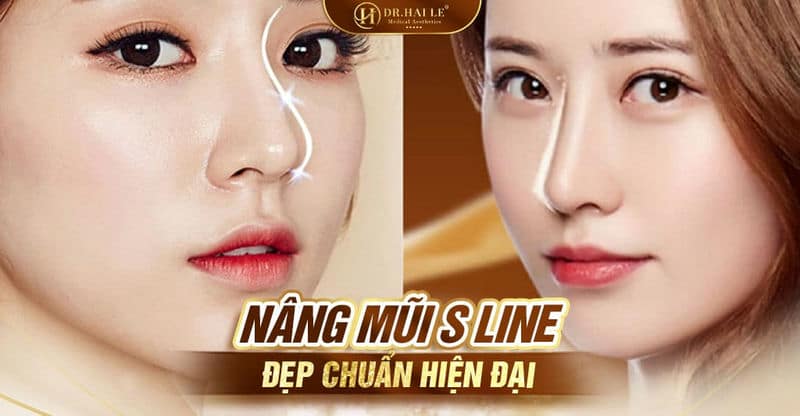 Nâng mũi S Line đẹp chuẩn hiện đại