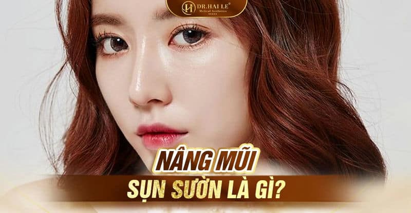 Nâng mũi sụn sườn là gì?