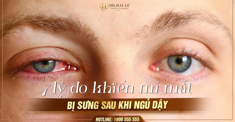 7 lý do khiến mí mắt bị sưng sau khi ngủ dậy