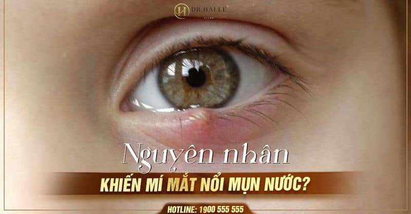 Nguyên nhân khiến mí mắt nổi mụn nước?