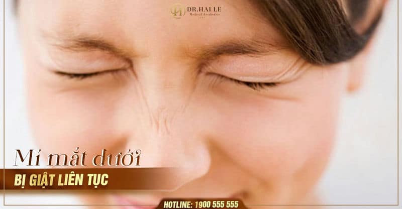 Đừng bỏ qua nếu mí mắt dưới của bạn bị giật liên tục