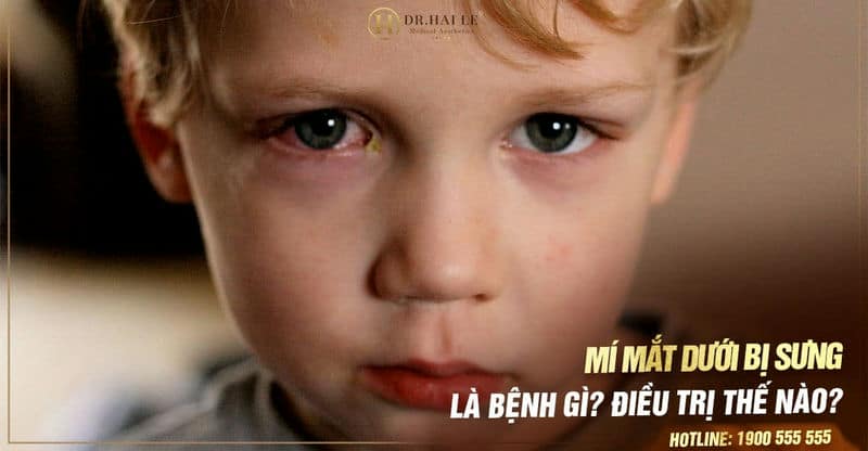 Mí mắt dưới bị sưng là bệnh gì?