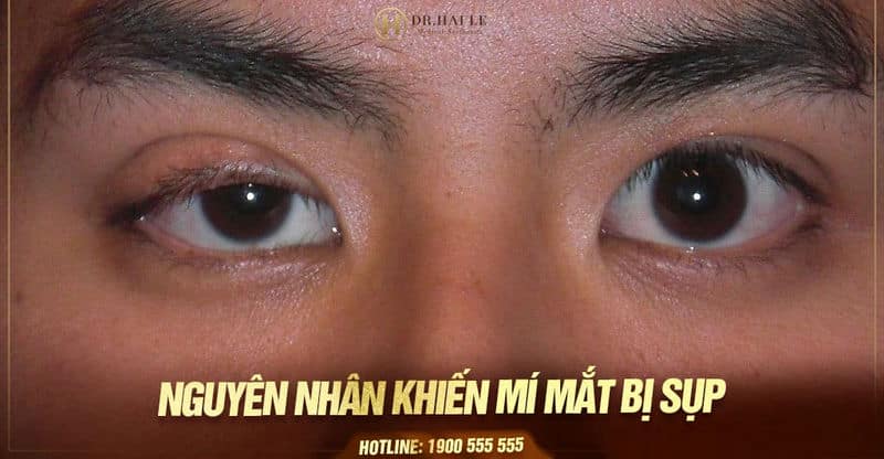 Nguyên nhân khiến mí mắt bị sụp