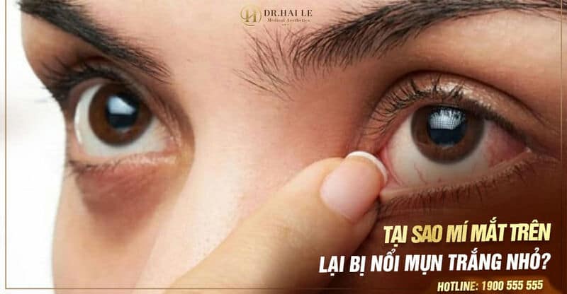 Tại sao mí mắt trên lại bị nổi mụn trắng nhỏ?