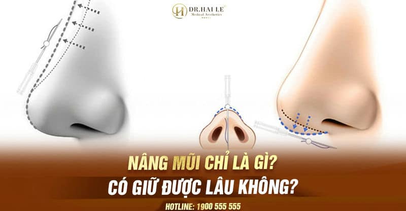 Nâng mũi chỉ là gì? Có giữ được lâu không?
