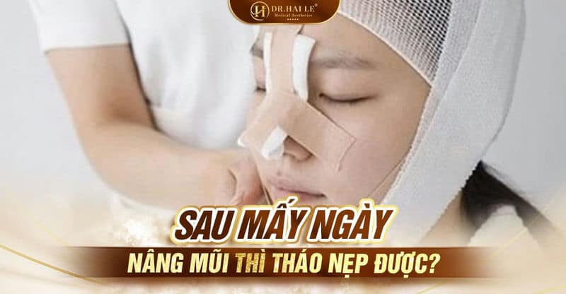 Sau mấy ngày nâng mũi thì tháo nẹp được?