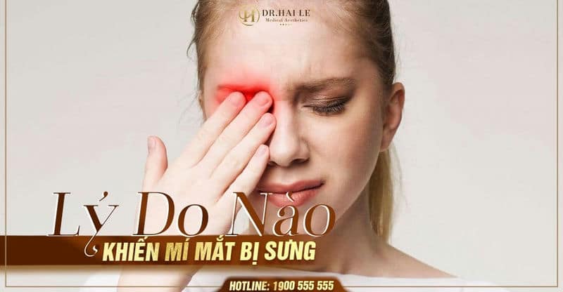 Lý do nào khiến mí mắt của bạn bị sưng?