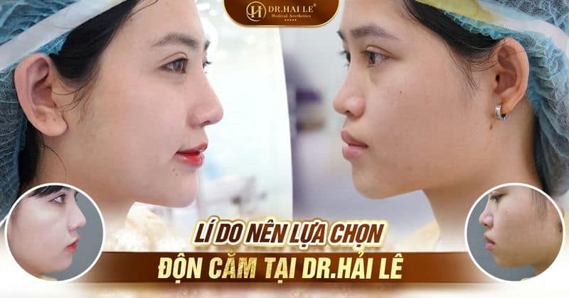 Lý do nên lựa chọn độn cằm tại Dr.Hải lê