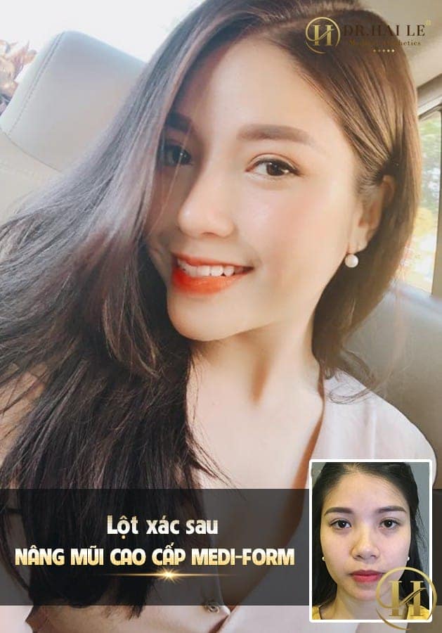 Đứng ở góc độ của những khách hàng đã từng đến Viện Thẩm Mỹ Y Khoa Dr.Hải Lê để làm đẹp, cụ thể là nâng mũi, đều vô cùng hài lòng và phản hồi rất tích cực