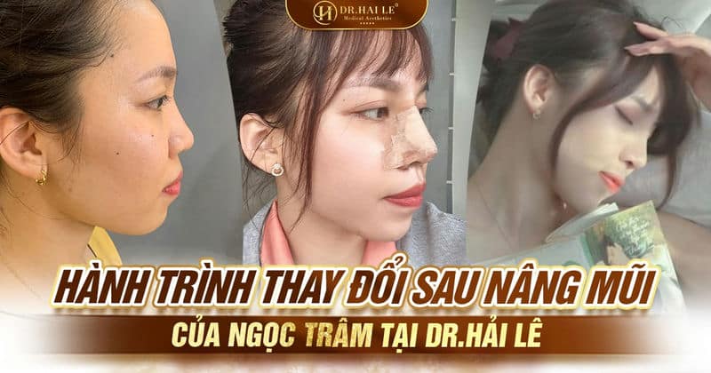 Hành trình thay đổi sau nâng mũi của Ngọc Trâm tại Dr.Hải Lê Hành trình thay đổi sau nâng mũi của Ngọc Trâm tại Dr.Hải Lê