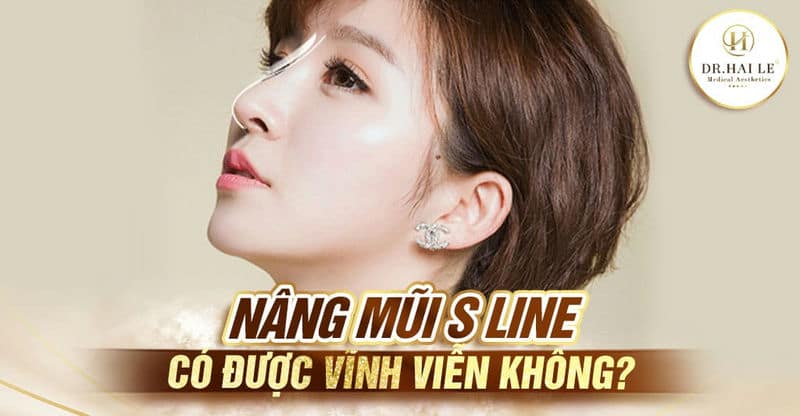 Nâng mũi S Line có được vĩnh viễn không?