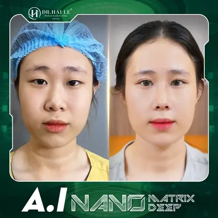 Cắt mí A.I Nano Matrix Deep